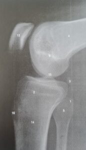 RTG kolana widok boczny oraz stawu rzepkowo-udowego
