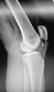 RTG stawów kolanowych