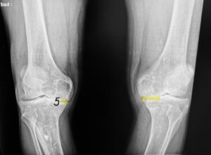 RTG stawów kolanowych